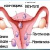 Fibrome Utérin Remède Naturel Fibrome Utérin