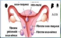 Fibrome Utérin Remède Naturel Fibrome Utérin