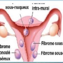Remède 010: Fibrome Utérin Remède Naturel Fibrome Utérin Solution Bio