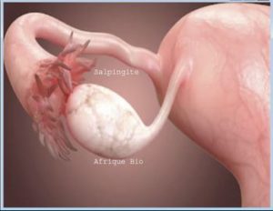 Lire la suite à propos de l’article Salpingite Causes Symptômes Traitement Naturel de la Salpingite