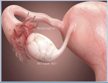 Lire la suite à propos de l’article Salpingite Causes Symptômes Traitement Naturel de la Salpingite
