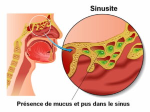 Traitement et Guérison Totale de la Sinusite