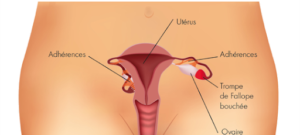 Lire la suite à propos de l’article Débloquer Résoudre L&rsquo;infertilité et Tomber Enceinte Trompes Bouchées Quelle Solution