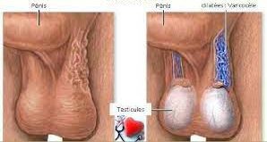 Lire la suite à propos de l’article Varicocèles Traitement Naturel Solution Sans La Chirurgie : Remède Naturel