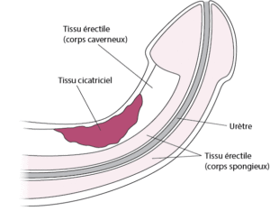 Traitement Naturel Dysfonction Erectile Remède Bio Naturel