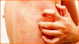 remède naturel les infections à levures