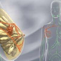 Remède 402 : Cancer du Sein Symptômes et Solution Naturelle