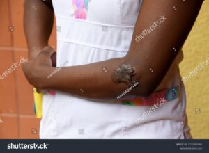 Traitement naturel contre les chéloïdes 