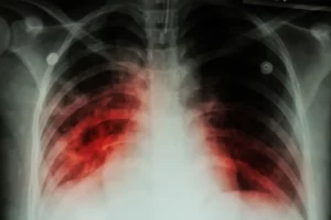Traitement naturel contre la tuberculose