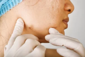 Remède naturel contre le kyste sébacé 